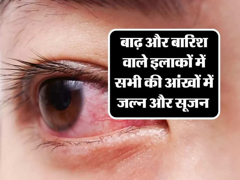 Eye flu : बाढ़ और बारिश वाले इलाकों में सभी की आंखों में जल्न और सूजन क्यों